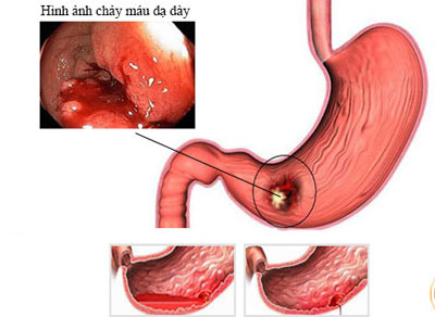 Viêm xưng huyết dạ dày