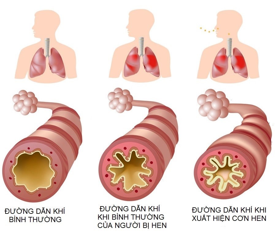 benh-hen-suyen-dau-hieu-nguyen-nhan-va-cach-phong-ngua