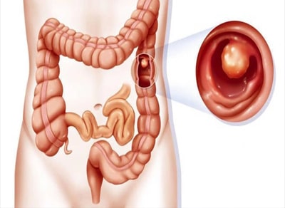 Bị bệnh đại tràng - Cách chữa bằng đông y
