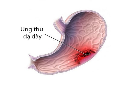 Ung thư dạ dày