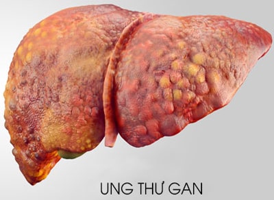Ung thư gan