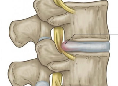 Thoát vị đĩa đệm